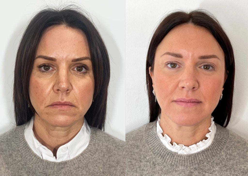 Before and after downturned mouth Botox treatment demonstrating natural smile lift and DAO muscle relaxation